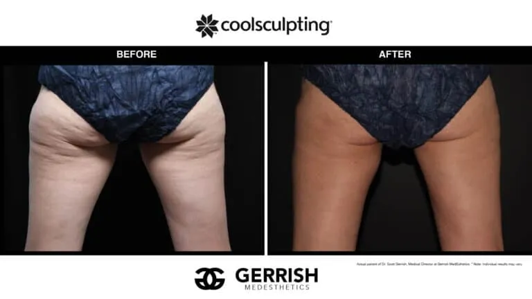 CoolSculpting before and after of thighs
