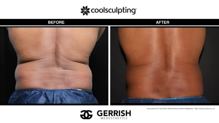 CoolSculpting before and after male waist