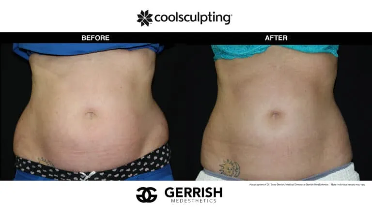 CoolSculpting before and after female waist