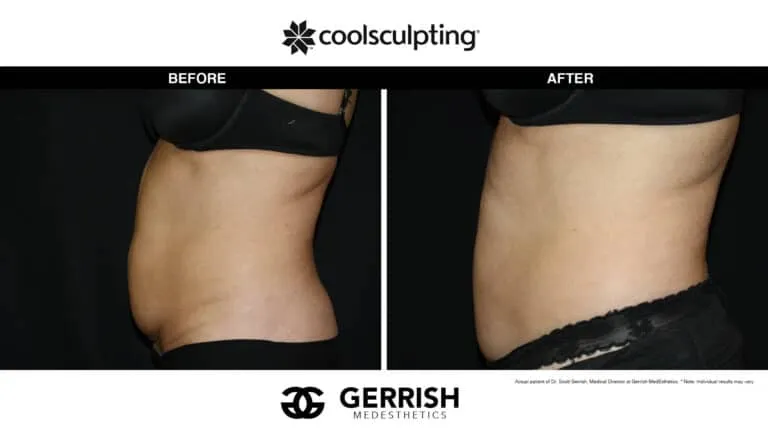 CoolSculpting before and after female waist