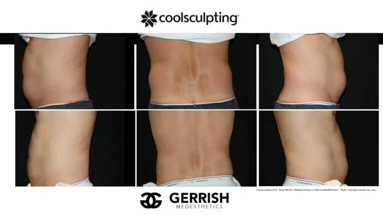 CoolSculpting before and after male stomach